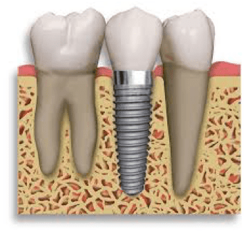 Zobni implantat prerez